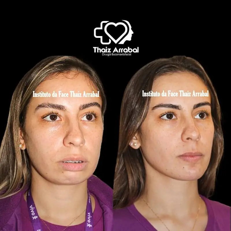 Antes e depois — registro clínico 7 do Instituto da Face