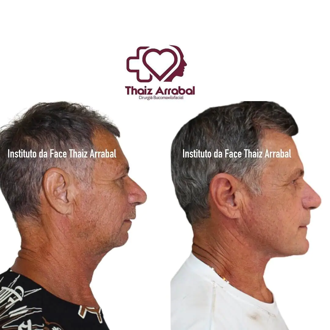 Antes e depois — registro clínico 11 do Instituto da Face