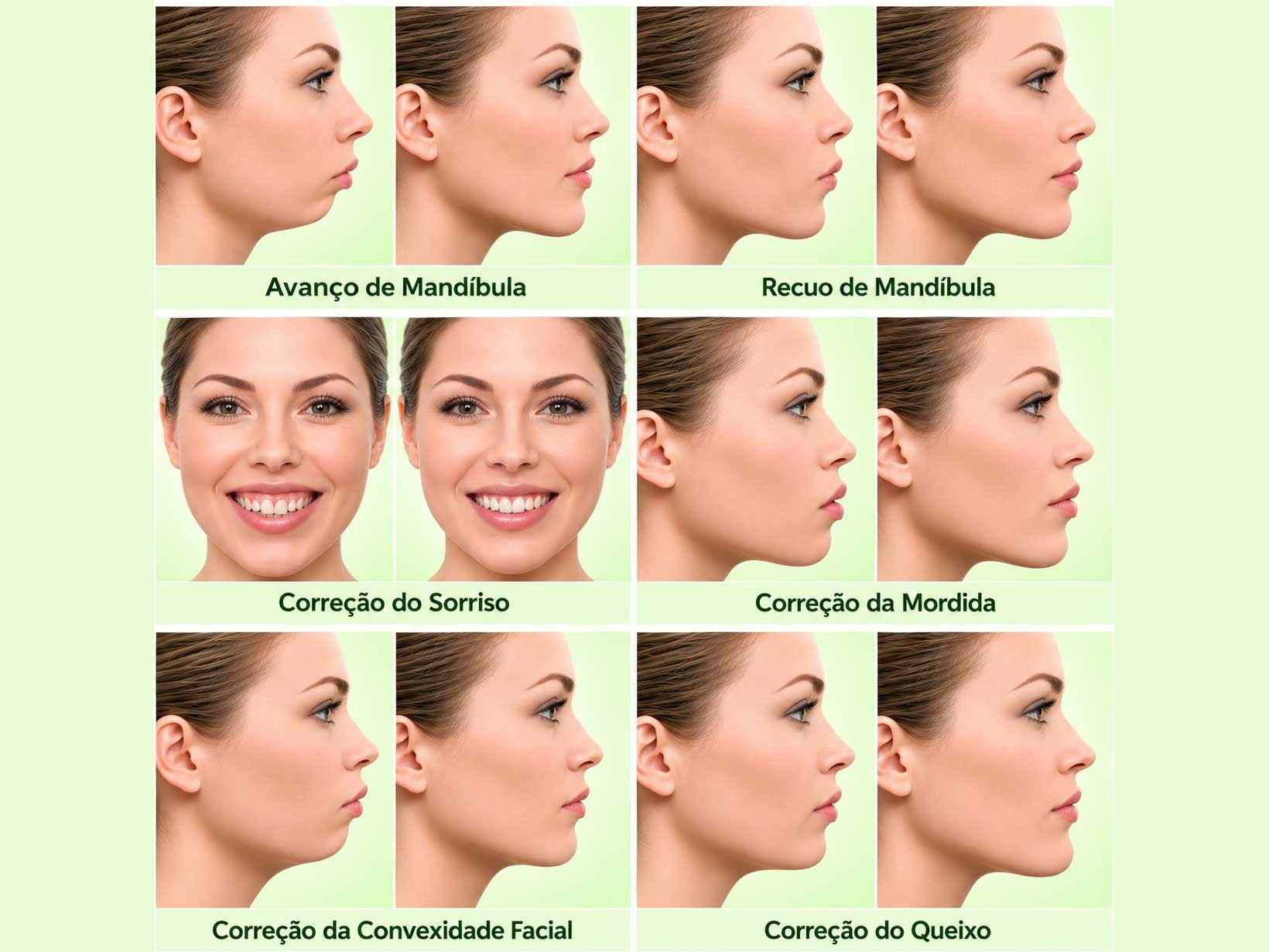 Ilustração comparativa de ajustes cirúrgicos: avanço de mandíbula, recuo de mandíbula, correção do sorriso, correção da mordida, correção da convexidade facial e correção do queixo