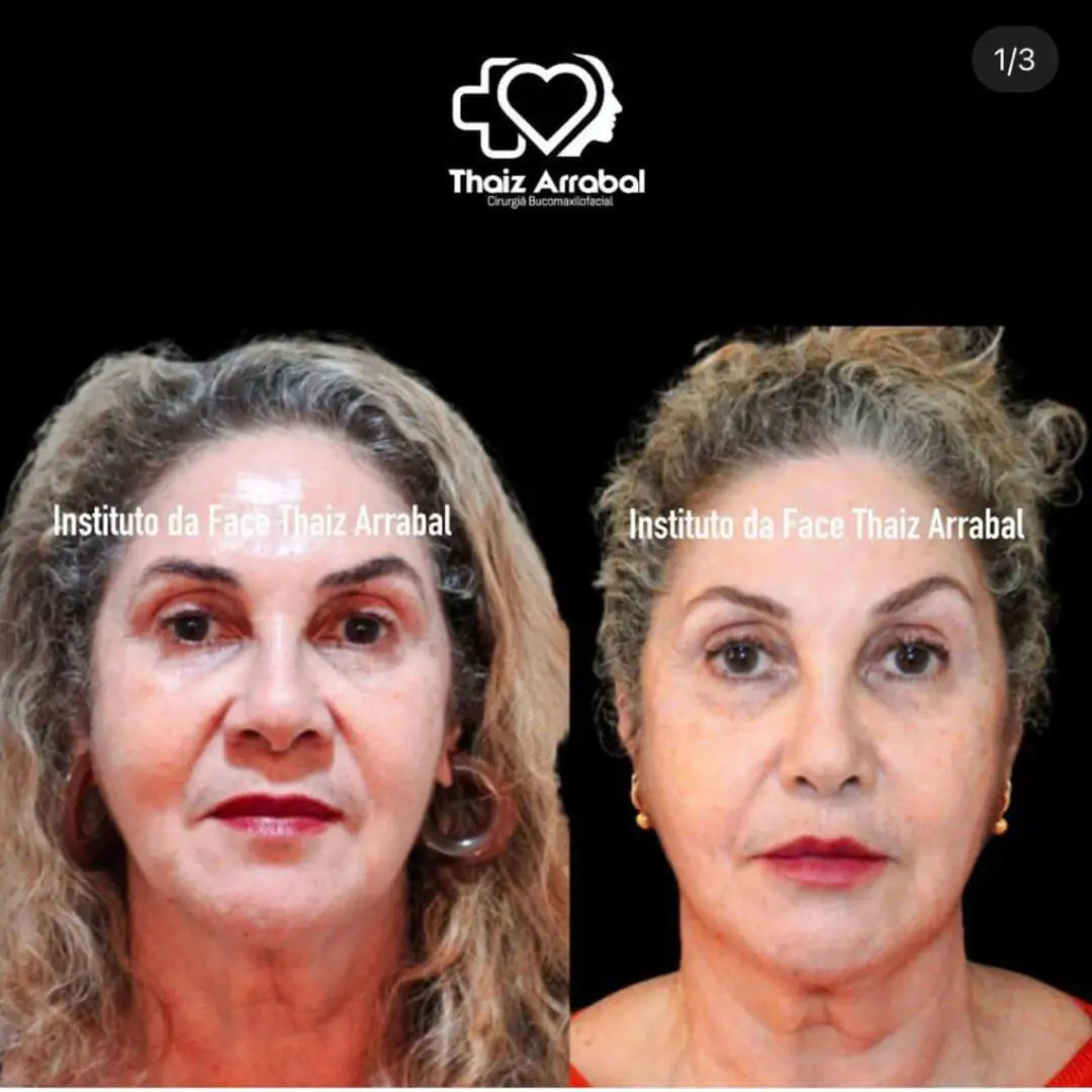 Antes e depois — registro clínico 3 do Instituto da Face
