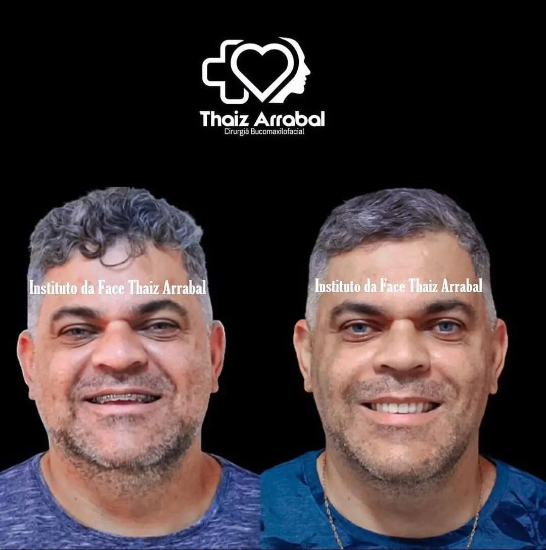 Antes e depois — registro clínico 13 do Instituto da Face