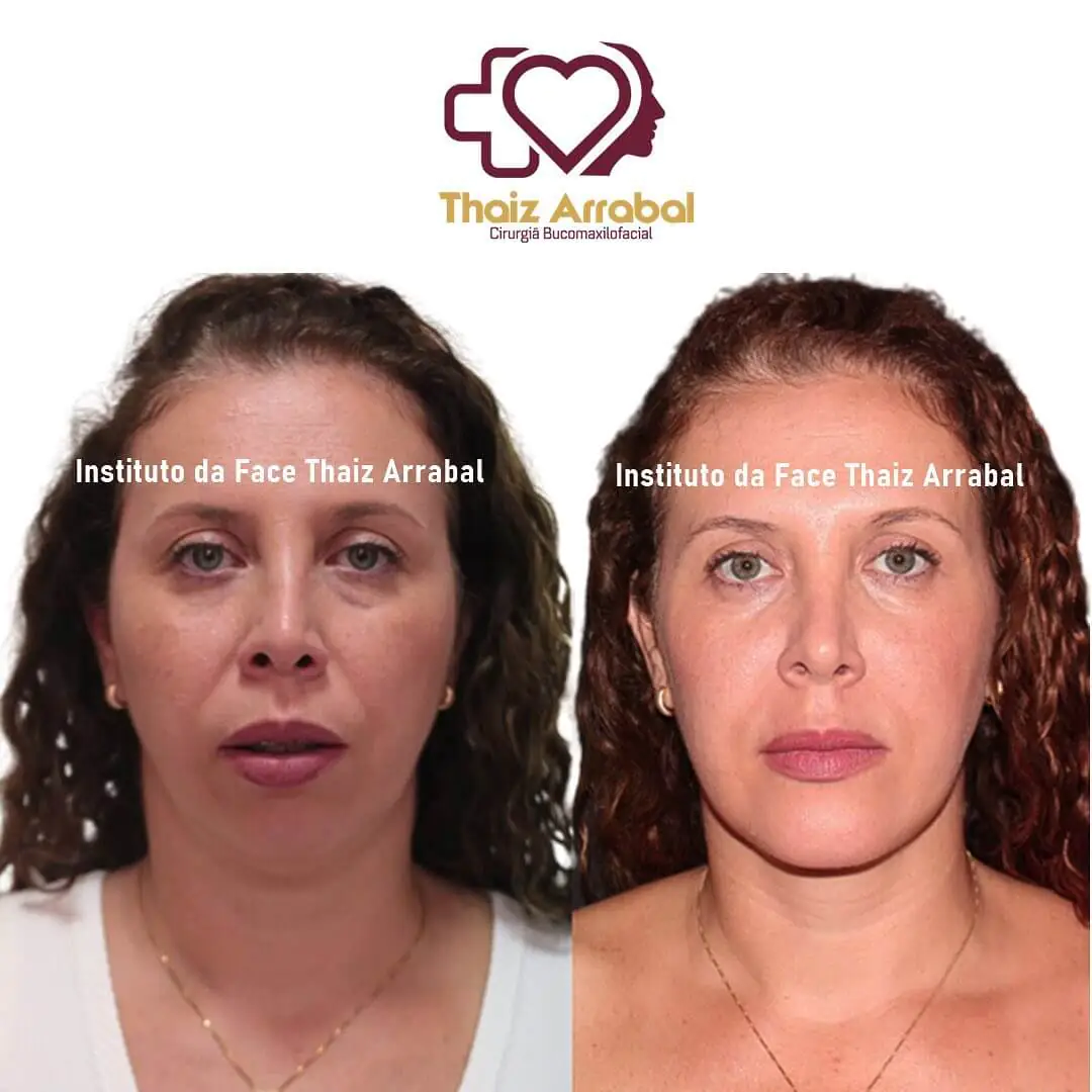 Antes e depois — registro clínico 17 do Instituto da Face