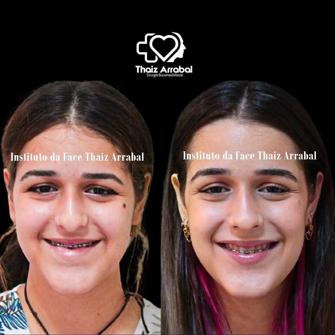 Antes e depois — registro clínico 5 do Instituto da Face