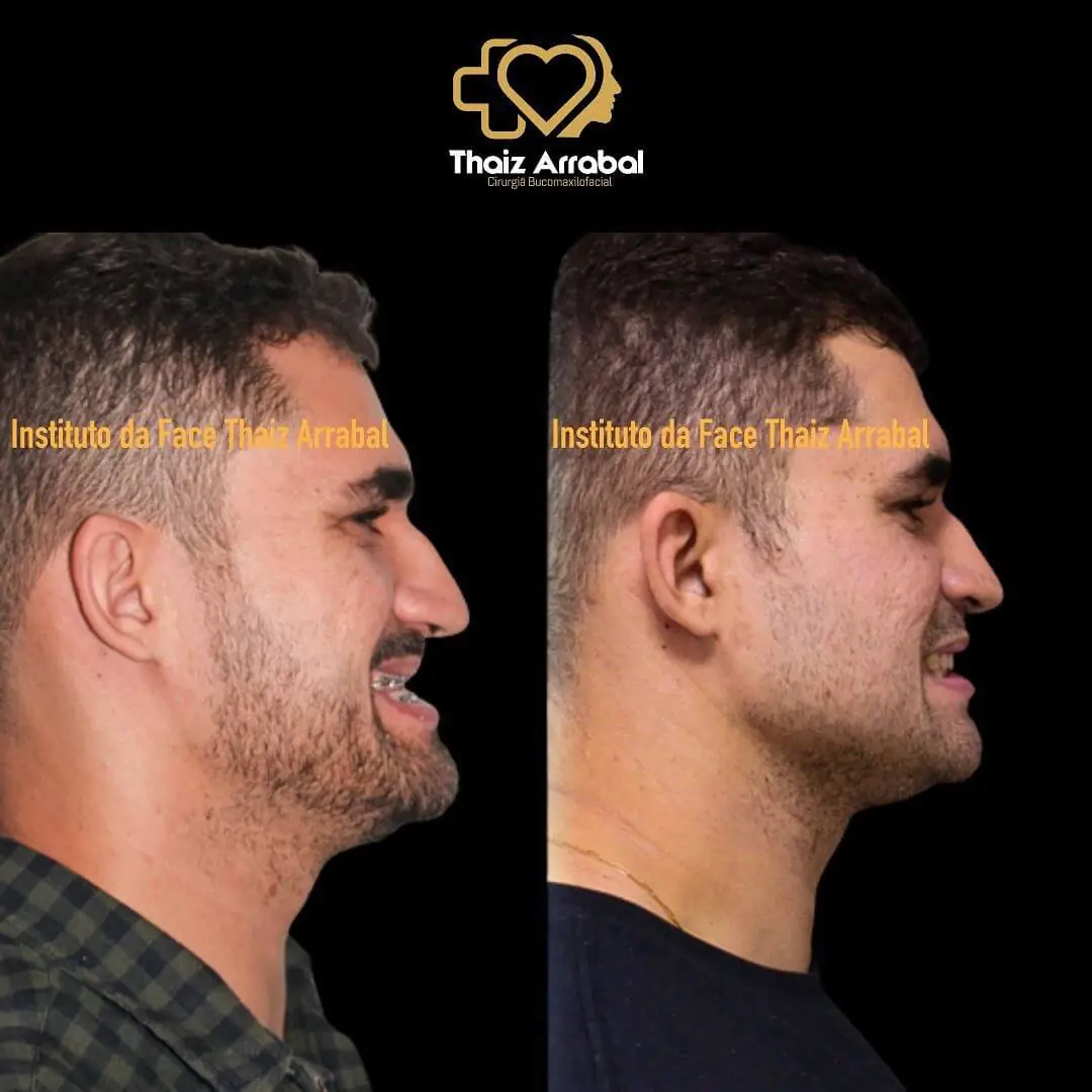 Antes e depois — registro clínico 21 do Instituto da Face