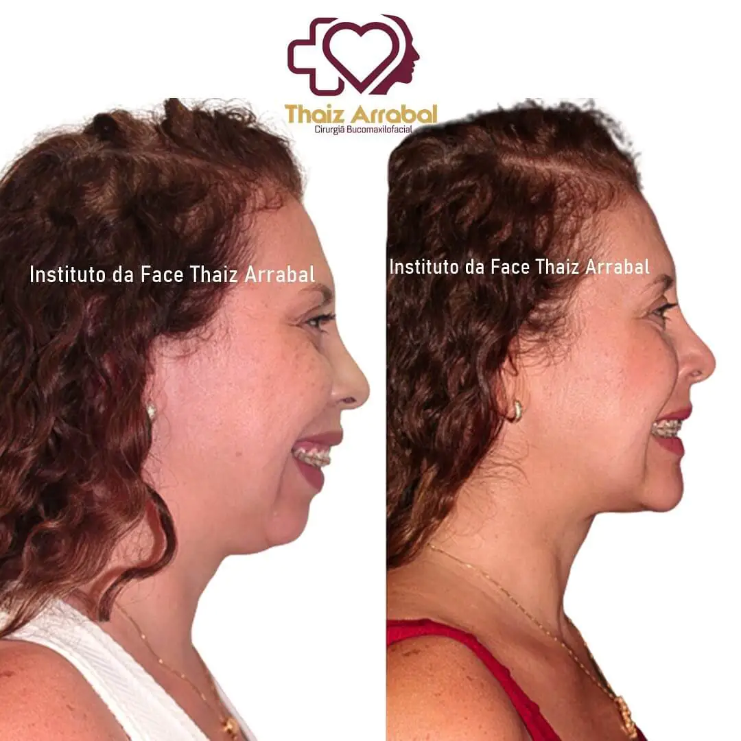 Antes e depois — registro clínico 20 do Instituto da Face