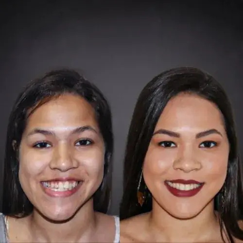 Antes e depois — registro clínico 4 do Instituto da Face