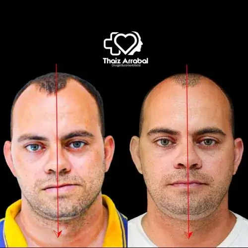 Antes e depois — registro clínico 1 do Instituto da Face