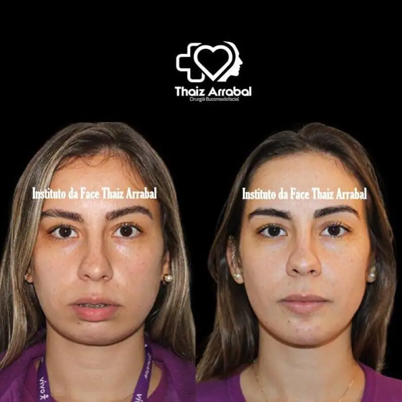 Antes e depois — registro clínico 6 do Instituto da Face